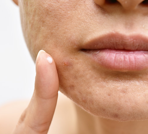 acne e sintomi pcos